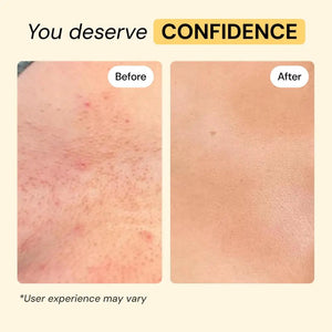MyMagicHealer Universal Flare Care – Multi-Purpose Solution | Skin Flare-Ups - Hidradenitis Suppurativa, Folliculitis, Boils, Cysts | Anti-Chafing | Irritated Skin Relief w/Propolis & Egg Yolk 1 oz MyMagicHealerBuy Supplements Australia