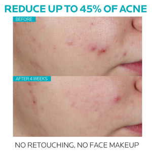 La Roche-Posay Effaclar Salicylic Acid Treatment to Minimize Pores, Clear Acne Blemishes and Post Acne Marks