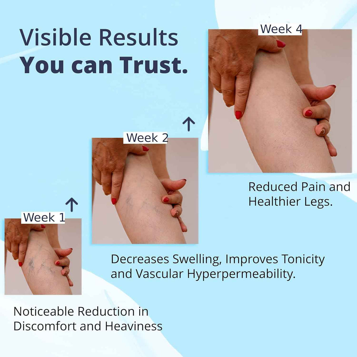 Cream Ayurvedic Solution for Management of Varicose Veins, Spider Veins, Varicocele Helps Reach The Root Cause of varicose Veins Reduces Cramps, Itching & Swelling. Single Tube (25 GMS).