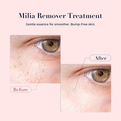 Milia Bump Remover Serum - Salicylic Acid Treatment (1.0 fl oz)
