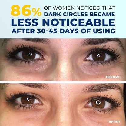 4-in-1 Under Eye Brightener – Anti-Aging Cream with 5% Caffeine, Niacinamide, Retinol & Peptides | Reduces Dark Circles, Puffiness & Wrinkles