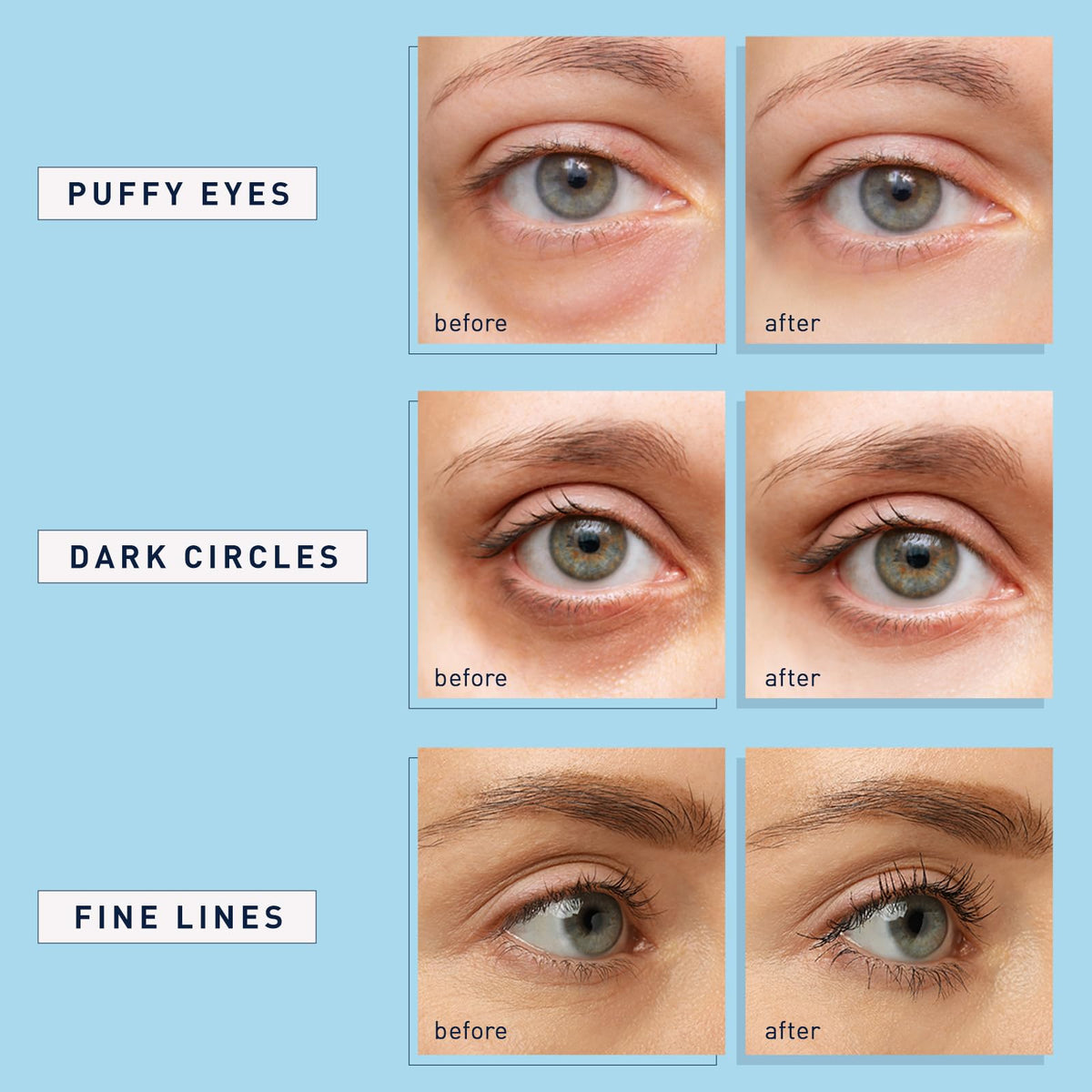 Enaskin Naturals Under Eye Patches (2-PACK / 60 Pairs) - Retinol & Collagen Blue Eye Mask Gels for Dark Circles & Puffiness