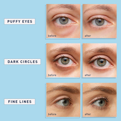 Enaskin Naturals Under Eye Patches (2-PACK / 60 Pairs) - Retinol & Collagen Blue Eye Mask Gels for Dark Circles & Puffiness
