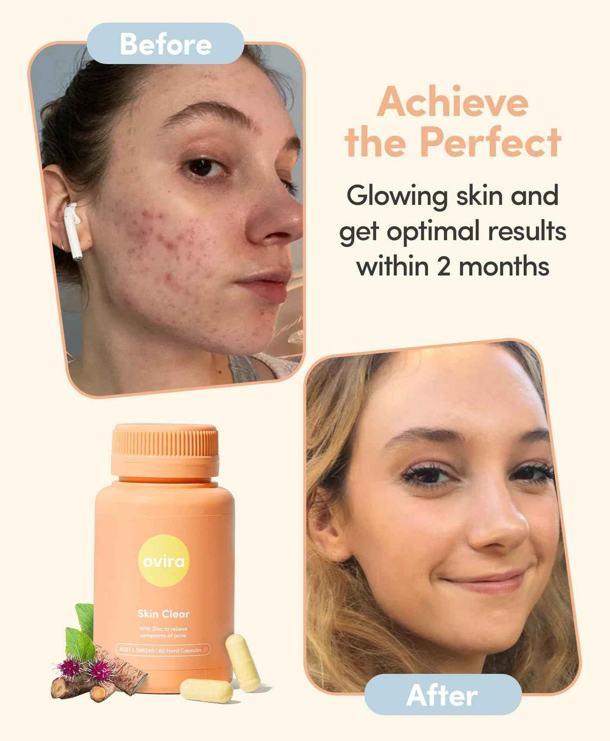 Ovira Skin Clear with ZINCBRIGHT - 60 Capsules for Clear and Glowing Skin - Rosacea & Hormonal Acne Treatment - Support Collagen Production - Acne Supplements for Women & Men - Pack of 2