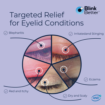 BlinkBetter BetterLids Eyelid Ointment (0.34 oz) – Deep-Moisturizing Oat Complex with Shea Butter & Panthenol for Dry, Itchy & Sensitive Skin