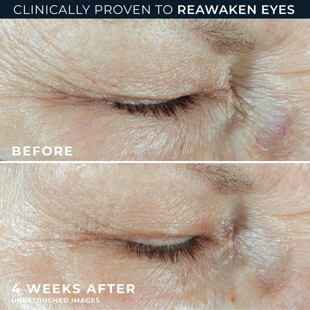 RoC Multi Correxion Hyaluronic Acid Eye Cream (0.5 oz) + Retinol Correxion Capsules (7 ct) - Anti-Aging Routine for Wrinkles, Puffiness & Dark Circles