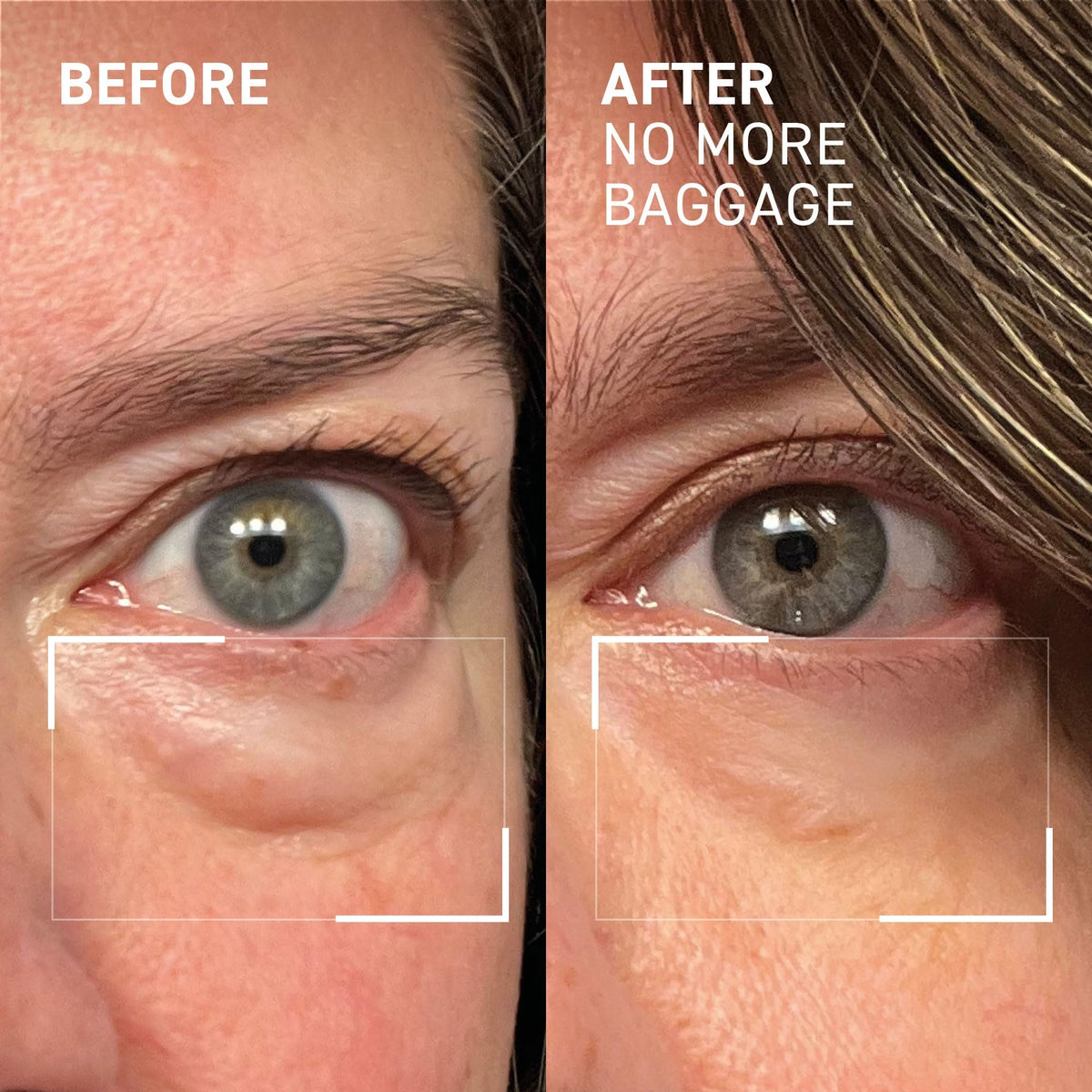 Dr. Brandt Needles No More, No More Baggage (Jumbo Size - 1 oz) – Instant Under-Eye De-Puffer & Dark Circle Eraser