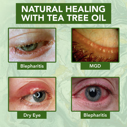 NOVEHA Tea Tree Oil Anti Wrinkle Eye Cream – Eyelid Cream for Dry & Itchy Skin, Hydrating Under Eye Treatment for Wrinkles, Dark Circles & Puffiness, Face Moisturizer – 1.69 Fl Oz