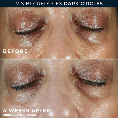RoC Multi Correxion 5 in 1 Anti-Aging Eye Cream (0.5 oz) - Comprehensive Treatment for Dark Circles, Puffiness & Wrinkles